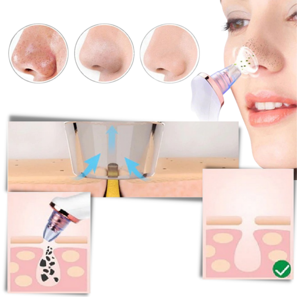 Blackhead Pore Remover Vacuum